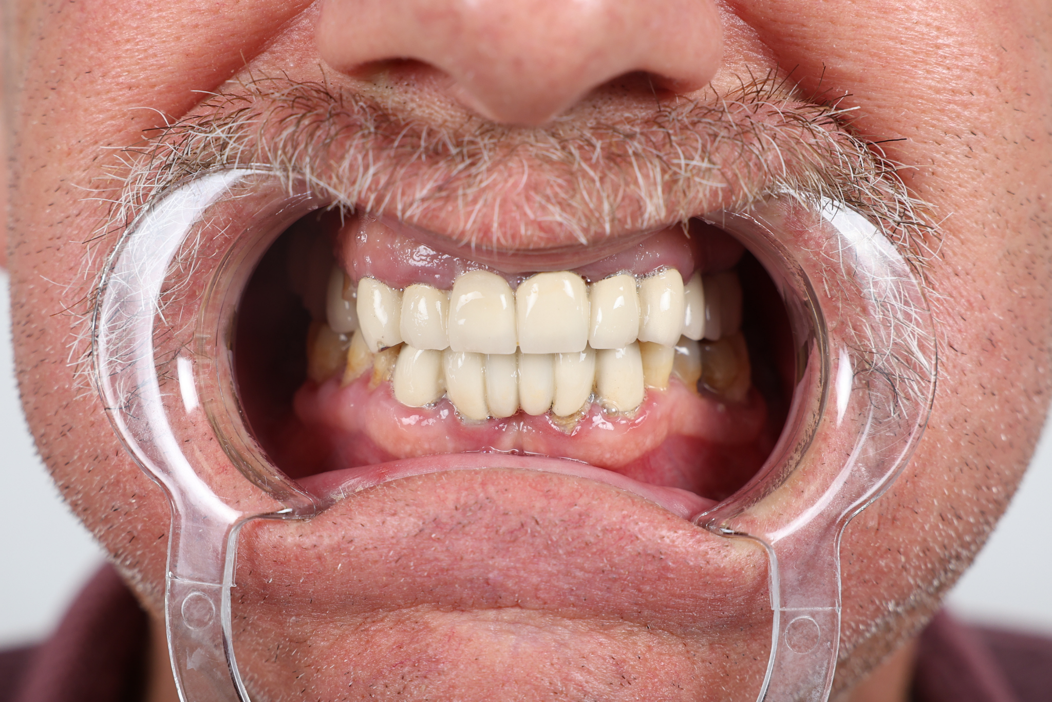 Before All-on-6 Implant Treatment